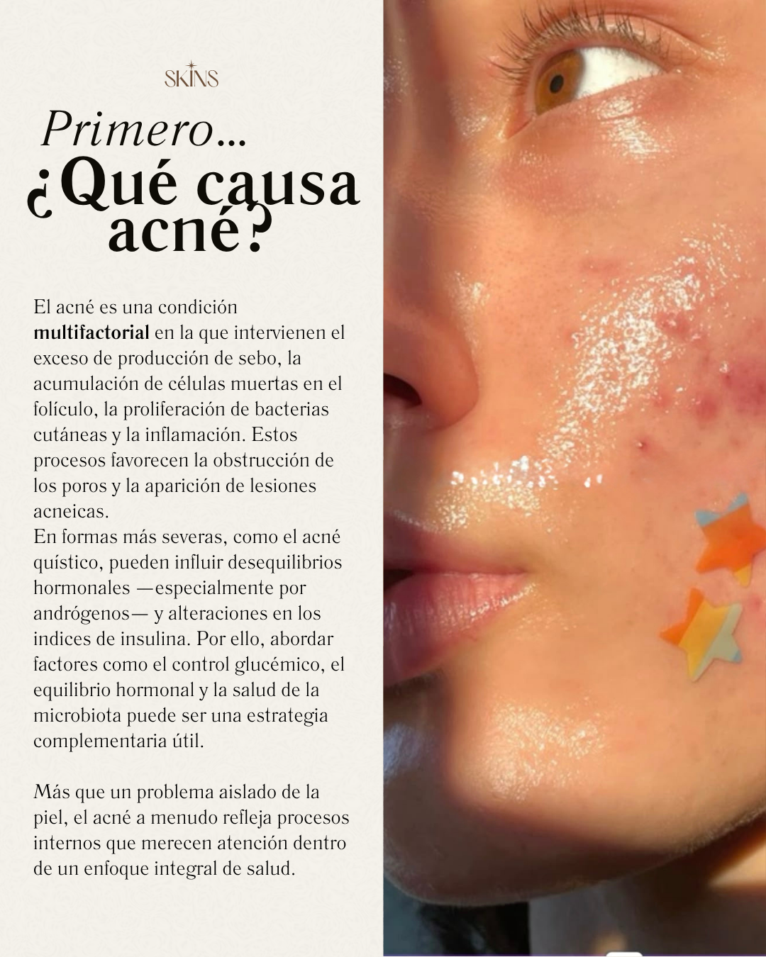Página interior de la guía sobre las causas del acné